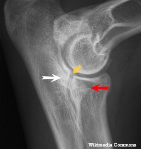 An Overview of Elbow Dysplasia