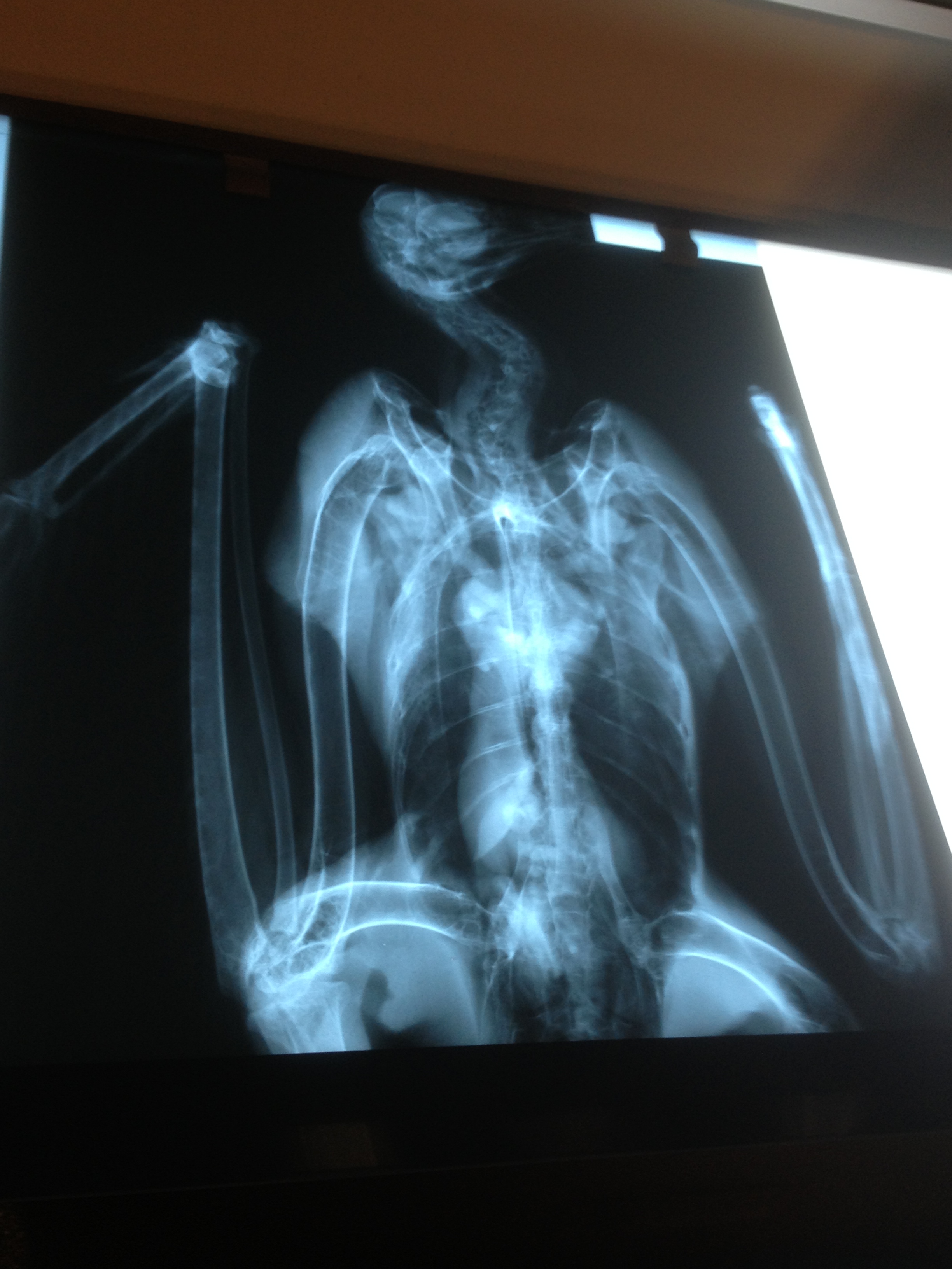 chest Xray