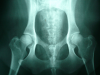 Canine Hip Dysplasia: An Overview