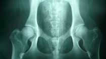 Canine Hip Dysplasia: An Overview