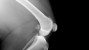 Anterior Cruciate Ligament Tear: What Happens When We Don’t Fix a Torn ACL?